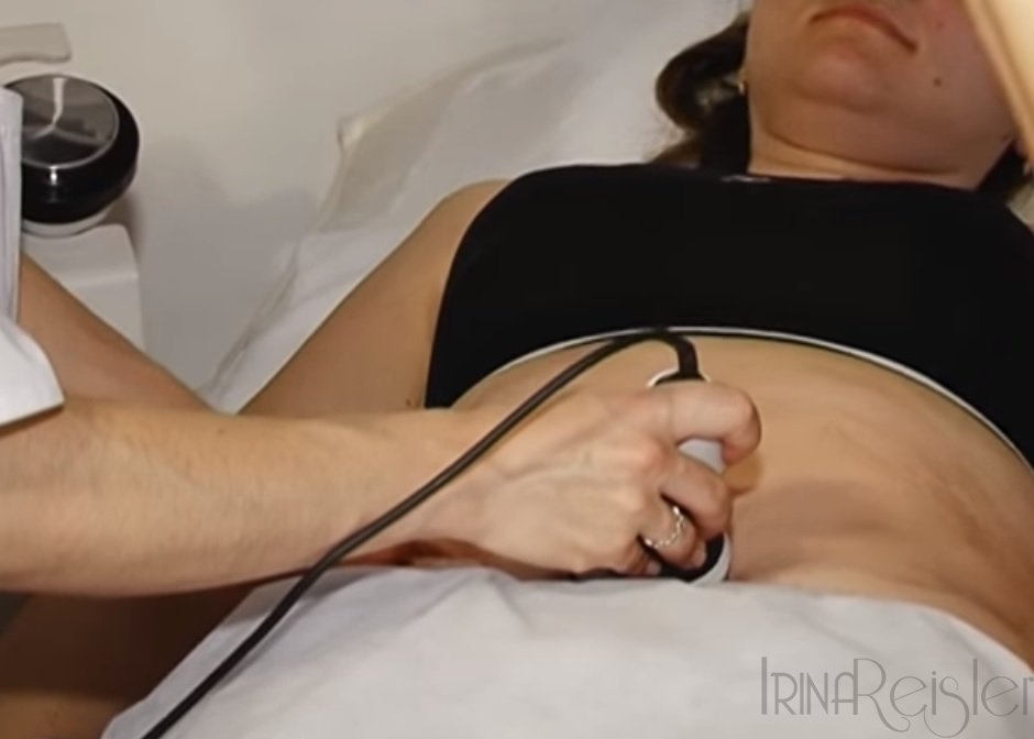 LIPOSUCTIA VIRTUALA TE AJUTA SA SLABESTI